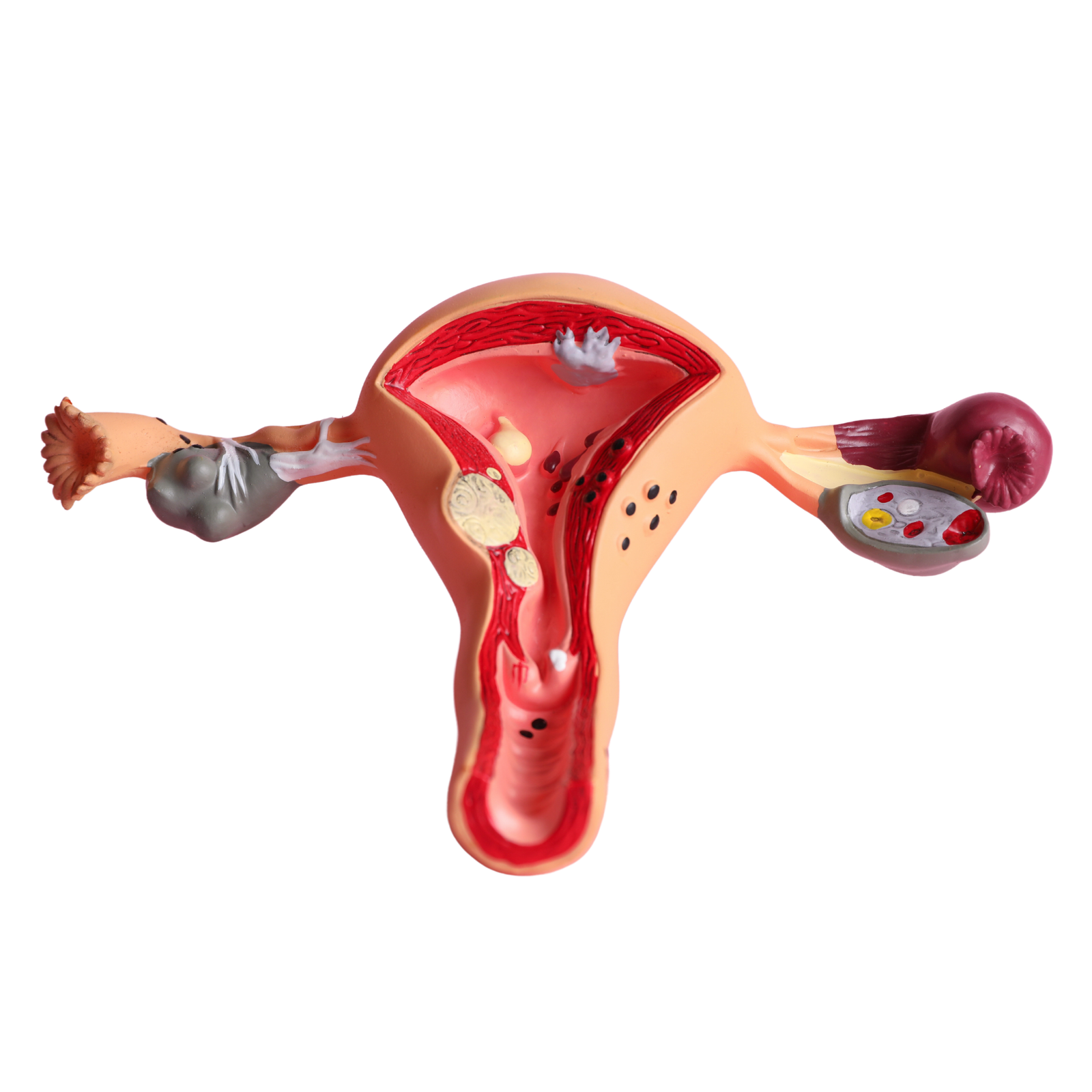 útero Endometriose